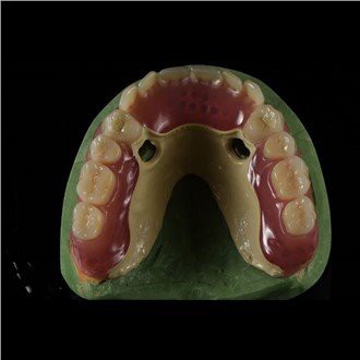 Zubní protéza Peek Framework